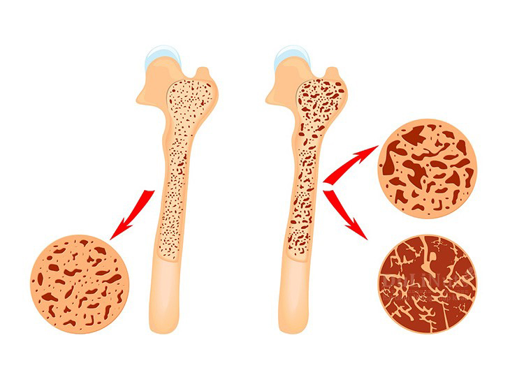 Tác dụng của quả óc chó với sức khỏe Óc chó giúp bảo vệ xương chắc khỏe